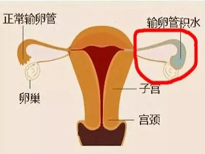 输卵管右侧伞端积水能怀孕吗
