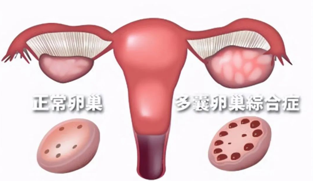 多囊卵巢不要不当一回事，多囊的危害你知道吗？