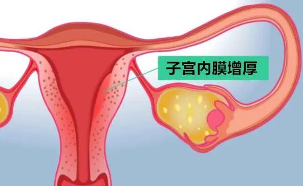 子宫内膜增厚是怀孕的症状吗