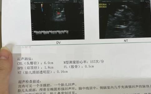 孕12周nt值0.16cm、头臀长6.2是男孩还是女孩，nt值看男女准确率高吗