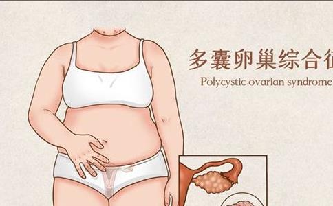 多囊卵巢综合征如何调理，推荐四个好方法。