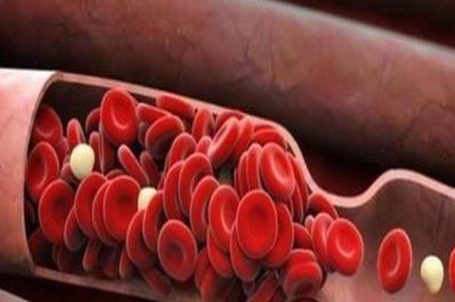 盘点血管堵塞的4个治疗方法，让你的血管恢复畅通
