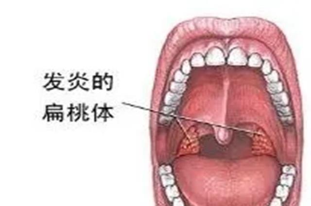 扁桃体发炎快好的4个征兆，恭喜你很快就可以继续活跃了