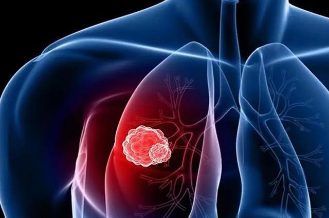 健康科普：盘点早期肺癌的6大症状，早发现能救命