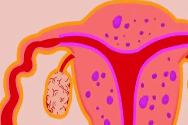 子宫腺肌症自然怀孕几率分析，4个好孕秘诀助你一臂之力