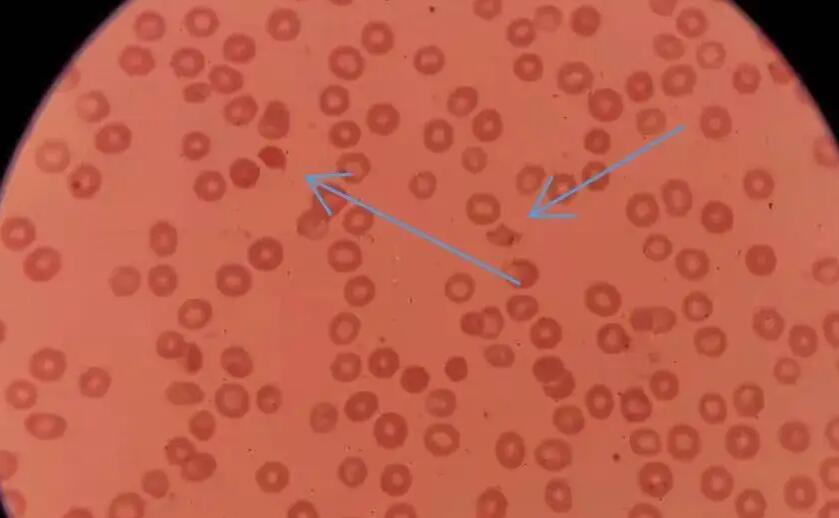 红细胞高是什么意思？红细胞变高意味着什么？