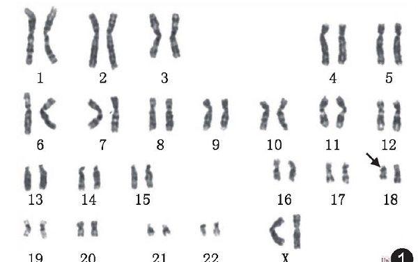 18号染色体异常六大类型：微重复、缺失对胎儿影响大