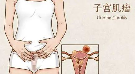 子宫肌瘤是什么原因导致的