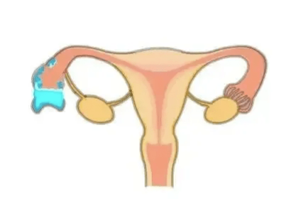 输卵管卵巢脓肿是怎么形成的